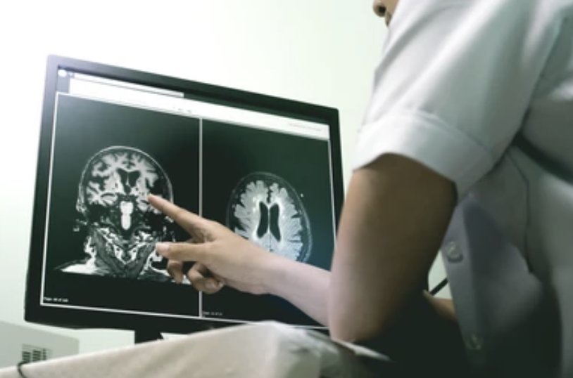 Neurologista Maceió - Acidente Vascular Cerebral (AVC) CID11 8B20